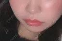 ヒアルロン酸注入（唇） / ヒアルロン酸注入（鼻翼基部） BiBiクリニック DAY 7 サムネイル用