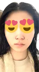 小鼻縮小（切開） くさのたろうクリニック DAY 2 サムネイル用