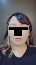糸リフト / バッカルファット除去 / 脂肪吸引（顔） / メーラーファット除去 / ジョールファット除去 / ボトックス（エラ・小顔） アリエル美容クリニック 大宮院 DAY 21 サムネイル用