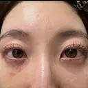 クマ治療 / 下まぶたの脂肪取り APOLLO BEAUTY CLINIC DAY 9 サムネイル用