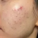 肌育注射（ジュベルックなど） Natural Skin Clinic 自由ヶ丘院 DAY 0 サムネイル用