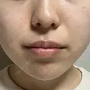 ヒアルロン酸注入（あご） / ヒアルロン酸注入（唇） / ボトックス（口角） フィラークリニック 大阪梅田院 DAY 0 サムネイル用