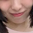 ヒアルロン酸注入（あご） / ヒアルロン酸注入（唇） / ボトックス（口角） フィラークリニック 大阪梅田院 DAY 2 サムネイル用