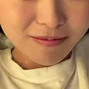 ヒアルロン酸注入（あご） / ヒアルロン酸注入（唇） / ボトックス（口角） フィラークリニック 大阪梅田院 AFTER サムネイル用