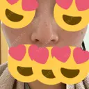 小鼻縮小（切開） アネシス美容クリニック DAY 20 サムネイル用