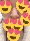 小鼻縮小（切開） アネシス美容クリニック DAY 20 サムネイル用