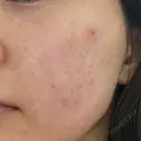 肌育注射（ジュベルックなど） Natural Skin Clinic 自由ヶ丘院 DAY 1 サムネイル用
