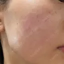 肌育注射（ジュベルックなど） Natural Skin Clinic 自由ヶ丘院 DAY 1 サムネイル用