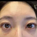 クマ治療 / 下まぶたの脂肪取り APOLLO BEAUTY CLINIC DAY 10 サムネイル用