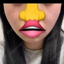 糸リフト / 脂肪吸引（顔） / 小鼻縮小（非切開） 形成外科と美容外科のクリニック池袋 AFTER サムネイル用