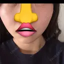 糸リフト / 脂肪吸引（顔） / 小鼻縮小（非切開） 形成外科と美容外科のクリニック池袋 DAY 17 サムネイル用