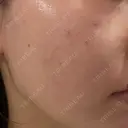肌育注射（ジュベルックなど） Natural Skin Clinic 自由ヶ丘院 DAY 2 サムネイル用