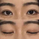 二重埋没 WOM CLINIC GINZA （ワム クリニック ギンザ） AFTER サムネイル用