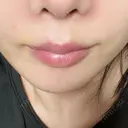 ボトックス（エラ・小顔） / ヒアルロン酸注入（唇） ルラ美容クリニック 名古屋栄院 / ルラスキンクリニック 名古屋栄院 DAY 37 サムネイル用