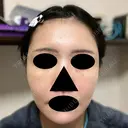 ヒアルロン酸注入（頬） / ヒアルロン酸注入（こめかみ） 仙台N美容クリニック AFTER サムネイル用