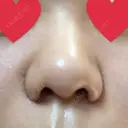 小鼻縮小（切開） ヴェリィ美容形成クリニック AFTER サムネイル用