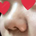 小鼻縮小（切開） ヴェリィ美容形成クリニック DAY 5 サムネイル用