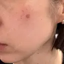 ボトックス（眉間） / 光治療（フォトフェイシャルなど） / ピコスポット Kaleido Clinic（カレイドクリニック） 横浜 DAY 0 サムネイル用