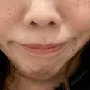 ボトックス（あご） / 肌ヒアルロン酸注入（たるみ・シワ改善） / 高濃度ビタミンC点滴 カジュアルクリニック 平塚院 AFTER サムネイル用