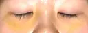 下まぶたの脂肪取り APOLLO BEAUTY CLINIC DAY 8 サムネイル用