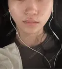 小鼻縮小（切開） くさのたろうクリニック DAY 7 サムネイル用