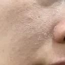 ヴェルヴェットスキン ゆう美容クリニック DAY 3 サムネイル用