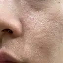 ヴェルヴェットスキン ゆう美容クリニック DAY 3 サムネイル用