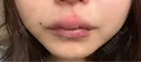 アートメイク（唇） 表参道メディカルクリニック 名古屋院 DAY 10 サムネイル用
