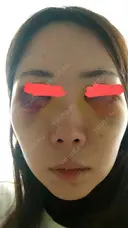 クマ治療 / 脂肪吸引（顔） / 脂肪注入（目の下） 湘南美容クリニック 千葉センシティ院 DAY 5 サムネイル用