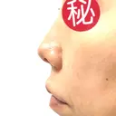 ヒアルロン酸注入（鼻） / ヒアルロン酸注入（唇） / ボトックス（目尻） HAAB×DREAM BEAUTY CLINIC 大阪梅田院 DAY 1 サムネイル用