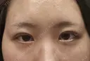 二重埋没 HAAB×DREAM BEAUTY CLINIC 大阪梅田院 DAY 0 サムネイル用