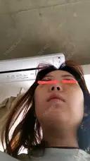 クマ治療 / 脂肪吸引（顔） / 脂肪注入（目の下） 湘南美容クリニック 千葉センシティ院 DAY 6 サムネイル用