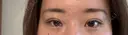 二重埋没 東京シンデレラ美容外科 池袋院 AFTER サムネイル用