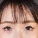 糸リフト / 目尻切開 / タレ目形成・グラマラスライン（切開） / ボトックス（あご） / ヒアルロン酸注入（あご） / ヒアルロン酸注入（鼻翼基部） Tokyo Tensei Clinic 新宿院 AFTER サムネイル用