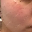 光治療（フォトフェイシャルなど） 81clinic DAY 4 サムネイル用