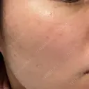 光治療（フォトフェイシャルなど） 81clinic DAY 7 サムネイル用