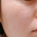 光治療（フォトフェイシャルなど） 81clinic DAY 10 サムネイル用