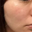 光治療（フォトフェイシャルなど） 81clinic DAY 11 サムネイル用