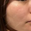 光治療（フォトフェイシャルなど） 81clinic AFTER サムネイル用
