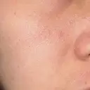 ヴェルヴェットスキン ゆう美容クリニック DAY 4 サムネイル用