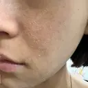 ヴェルヴェットスキン ゆう美容クリニック DAY 4 サムネイル用