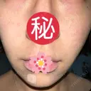 ヴェルヴェットスキン ゆう美容クリニック DAY 4 サムネイル用