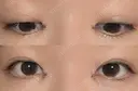 目頭切開 くさのたろうクリニック DAY 2 サムネイル用
