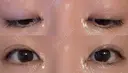 目頭切開 くさのたろうクリニック DAY 3 サムネイル用