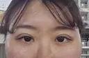 二重埋没 HAAB×DREAM BEAUTY CLINIC 大阪梅田院 DAY 2 サムネイル用