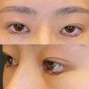 タレ目形成・グラマラスライン（埋没） LOUIS CLINIC 二子玉川院【ルイクリニック】 DAY 0 サムネイル用