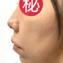 ヒアルロン酸注入（鼻） / ヒアルロン酸注入（唇） / ボトックス（目尻） HAAB×DREAM BEAUTY CLINIC 大阪梅田院 DAY 4 サムネイル用