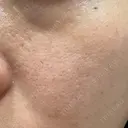 ヴェルヴェットスキン ゆう美容クリニック DAY 5 サムネイル用