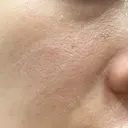 ヴェルヴェットスキン ゆう美容クリニック DAY 5 サムネイル用