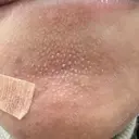 ヴェルヴェットスキン ゆう美容クリニック DAY 5 サムネイル用